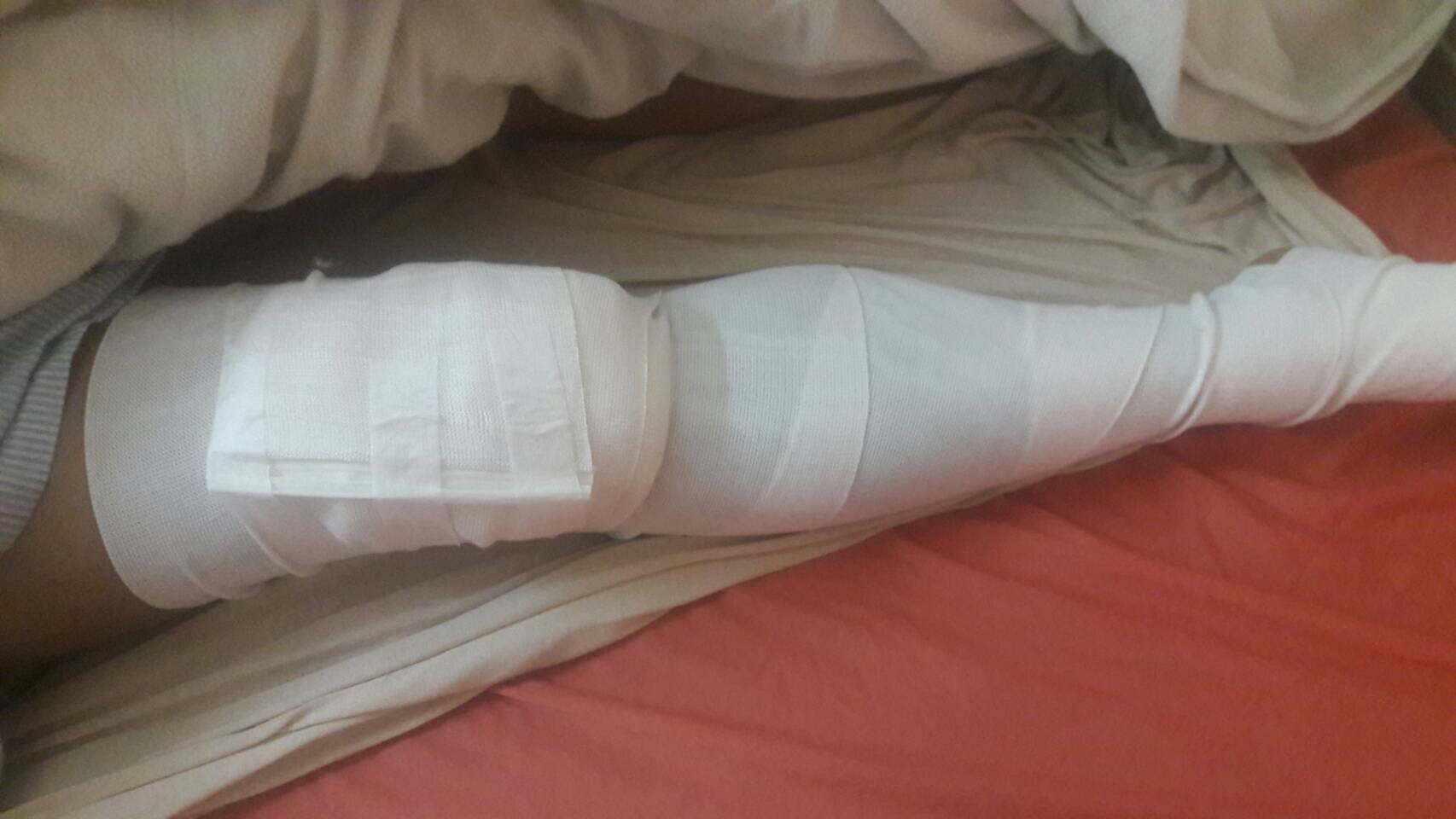 腿部在床上以繃帶與敷料包紮的紀錄